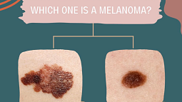 text says "which one is melanoma" above skin with potential skin cancer